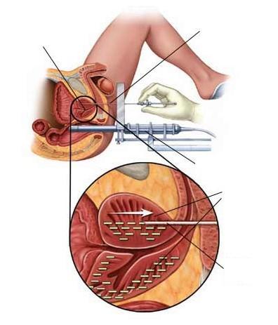 Brachytherapie prostaat