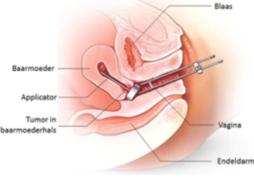 Iridium inwendige bestraling baarmoederhals